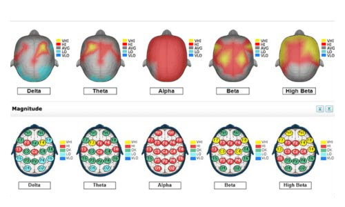 Neurofeedback